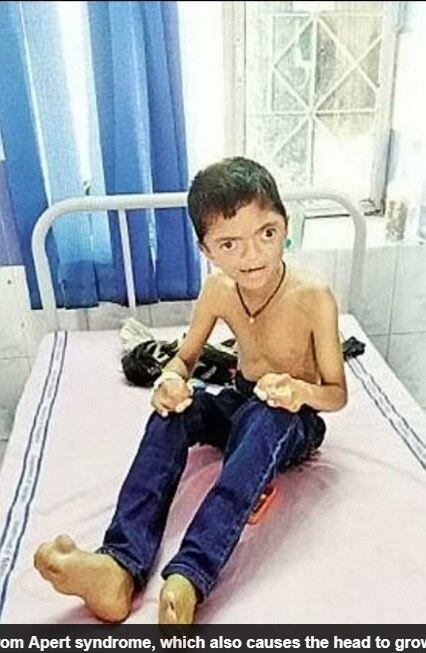 Por
isso, seus pais precisam arrecadar um milhão de rupias, cerca de R$ 49 mil para
realizar a cirurgia reconstrutiva. Eles precisam de metade da quantia para que
possam iniciar o tratamento