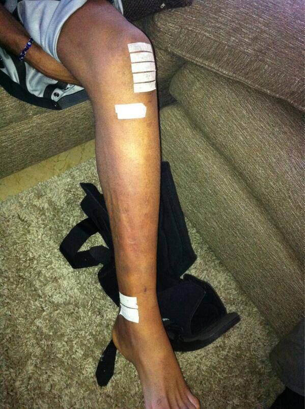Em sua conta no Twitter, Dana White publicou uma foto da canela esquerda de Anderson Silva apenas com curativos da cirurgia. É possível ver também a cicatriz da cirurgia realizada no fim do ano passado