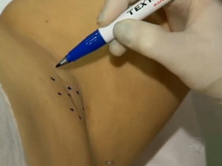 A toxina botulínica é muito eficaz no tratamento de pessoas com suor excessivo

No R7 Play você pode assistir ao Fala Brasil na íntegra! Clique e experimente de graça!
+ Botox ajuda no tratamento de enxaqueca, bruxismo e suor excessivo


