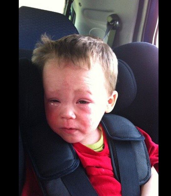 O irmão, Jenson, ajuda
Morgan quando ele está se coçando e passa o creme que suaviza a coceira, conta
a mãe