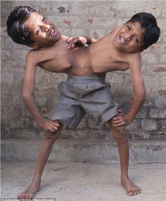 Os gêmeos siameses Shivanath e Shivram Sahu causaram grande alvoroço quando nasceram na Índia, há 12 anos. Algumas pessoas na vila onde seus pais viviam os adoraram como se eles fossem encarnações divinas Veja o que aconteceu com os gêmeos