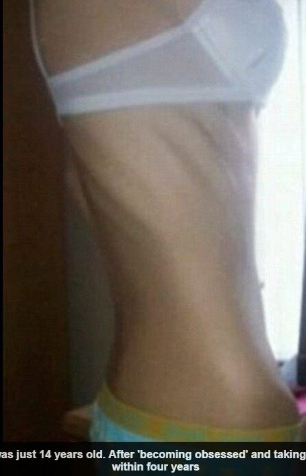 Além dos cortes drásticos de comida, a adolescente também
resolveu se exercitar regularmente. 



— Eu me sentia tonta o tempo todo e não conseguia
me concentrar em qualquer atividade. Mesmo assim, me forçava a fazer os exercícios
no período da manhã