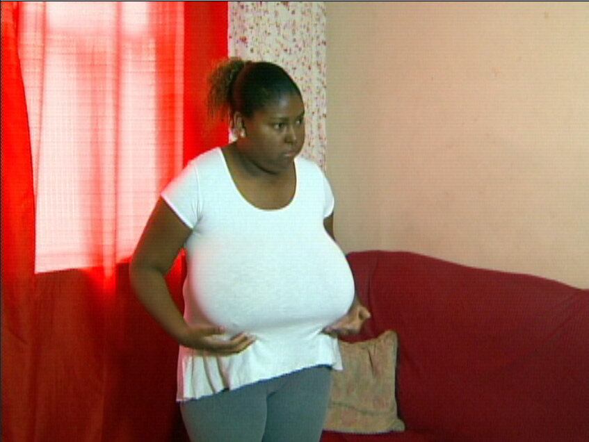 Cada seio de Mayara pesa cerca de 1 kg. Ela sofre depressão
e diz que quase não tem disposição para sair da cama