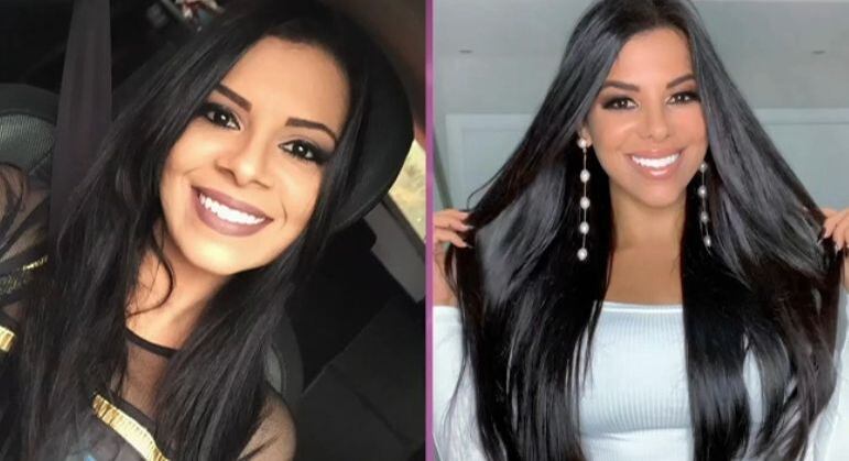 Evelyn Regly recorre a procedimentos para reverter efeitos indesejados da bichectomia