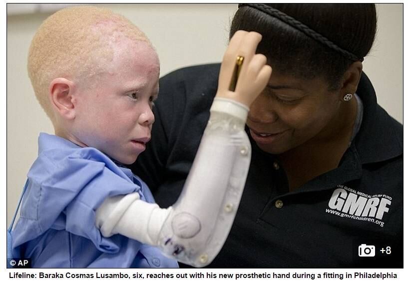 O pai do menino foi preso acusado de ter participado do ataque. Segundo a assistente social Ester Rwela, muitos parentes de albinos na África acreditam que seus filhos são amaldiçoados
