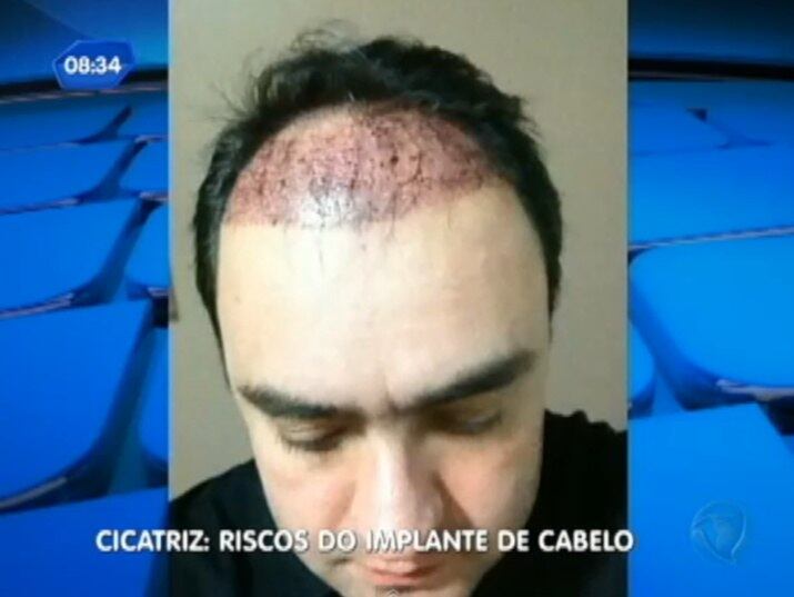 Maria Angela Muricy, dermatologista especialista em implantes capilar,
garante que os riscos são pequenos.
— Milhares de pessoas têm transplantes, alguns casos maus sucedidos
falam contra a técnica em si
+ Implante capilar: conheça os riscos do procedimento