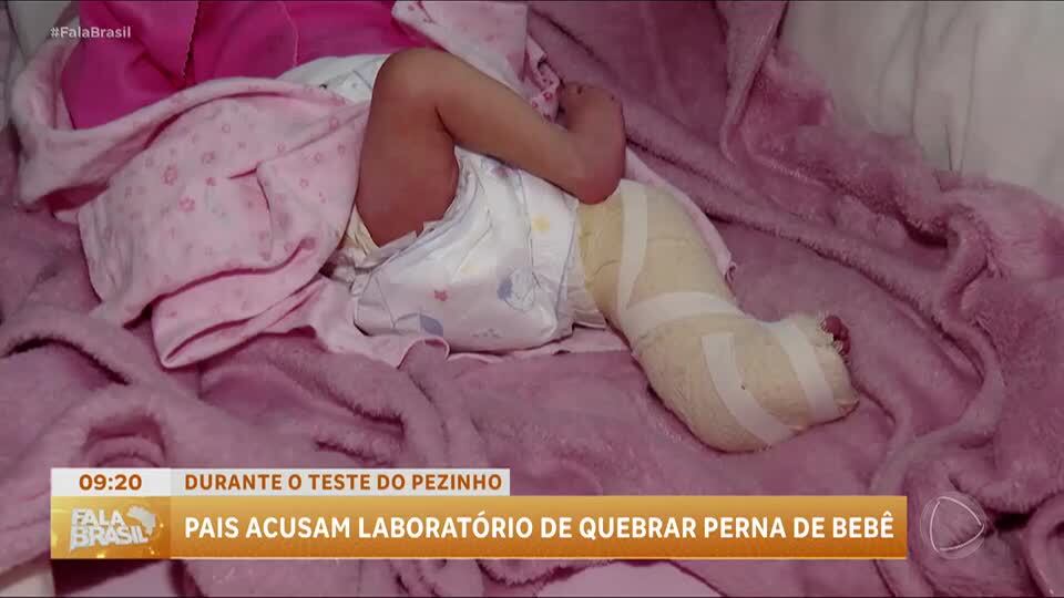 Bebê prematura de Goiânia sofre fratura no fêmur após teste do pezinho