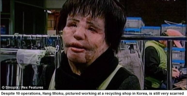 Em 2013, a ex- modelo coreana Asa Mioku chocou ao contar que injetou óleo de cozinha em seu rosto, após os médicos terem se recusado a fazer mais uma cirurgia facial. Por causa das aplicações, ela ficou totalmente deformada