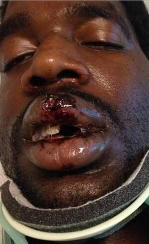 Acidente fez com que o homem ficasse com o pescoço quebrado e a boca queimada