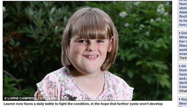 Segundo a mãe, o cisto pode se desenvolver novamente e a recuperação é de dois meses.

— Se Lauren sofrer uma recaída, nós a levamos ao hospital para tratar e monitorar a doença

