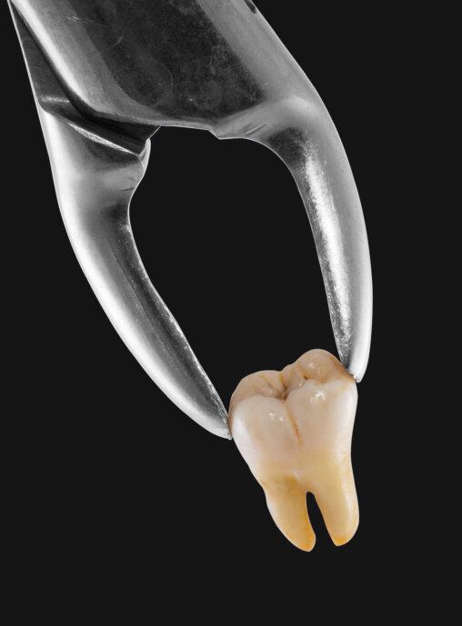 O repouso é necessário após a retirada do dente? Verdade

A extração do dente do siso é um procedimento cirúrgico, por isso, o repouso é necessário. O tempo dependerá do nível de complexidade da cirurgia. Há dentes do siso que são facilmente removidos, sem deixar uma ferida cirúrgica muito extensa. Já nos casos mais complicados, é indicado mais tempo de repouso, dependendo da recuperação e resposta inflamatória do paciente

