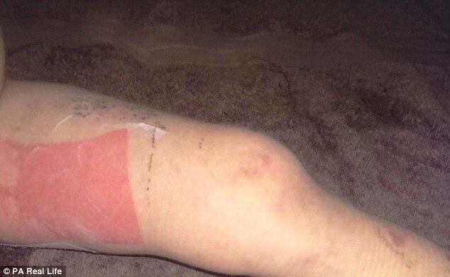 Foram quatro semanas no hospital até que a pequena Jazmyn pudesse voltar para a casa. Agora, ela está quase curada, sente apenas algumas dores nas pernas e nos nervos. A menina vai com frequência ao hospital Adelaide para acompanhamento. Recentemente, seus pais enviaram uma petição ao parlamento australiano pedindo que a vacina contra a meningocócica B seja introduzida na lista padrão de imunizações
