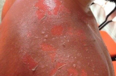 Johny Hendricks postou imagem de sua inusitada lesão