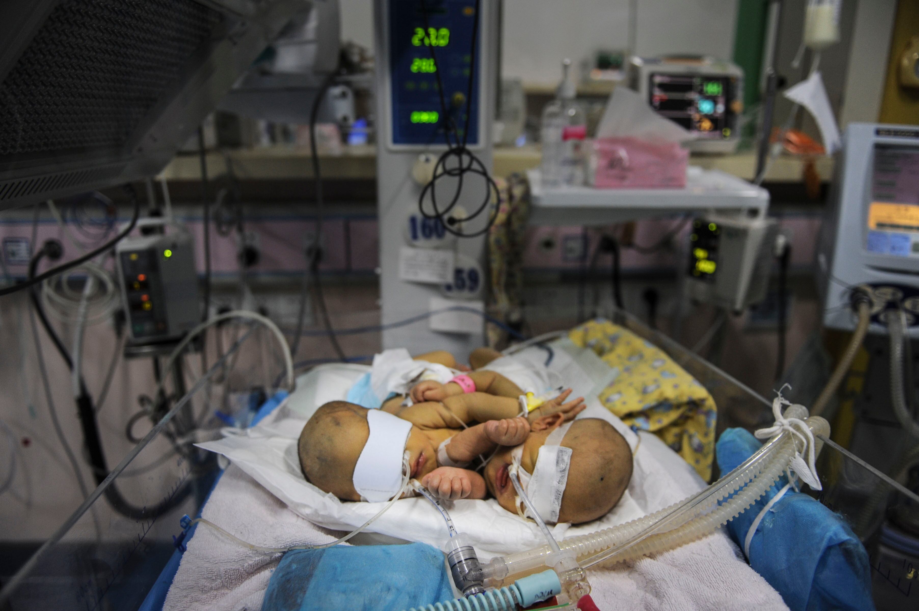 A notícia sobre o nascimento de bebês siameses chamou tanta atenção na China que muitas pessoas doaram dinheiro para colaborar no tratamento dos gêmeos. A expectativa é que em breve eles sejam separados

Gêmeas siamesas ganham programa de televisão