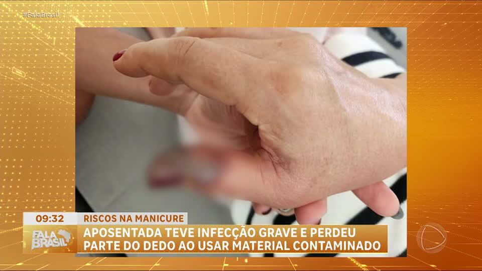 Após fazer as unhas, aposentada tem infecção grave no dedo