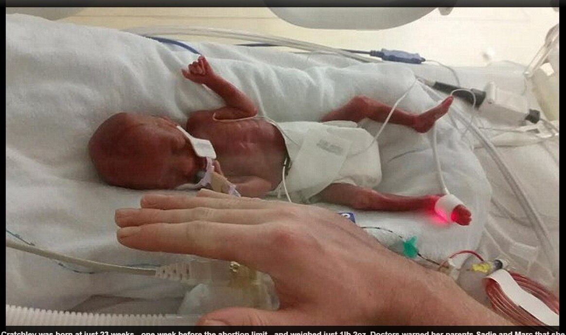Quando Sadie
Cratchley entrou em trabalho de parto quatro meses antes da hora, os médicos
avisaram-na para esperar pelo pior. Segundo eles, sua filha teria apenas 1% de
chances de sobreviver — e, por isso, eles sugeriram à mãe que deixasse sua bebê
“ir embora”.




No
entanto, a grávida, de apenas 20 anos na época, se recusou a desistir de sua
própria filha. Com isso, a minúscula Kaci-Rose Cratchley nasceu às 23 semanas
de gestação, pesando pouco mais de 40 g, algo como metade de um saco de açúcar