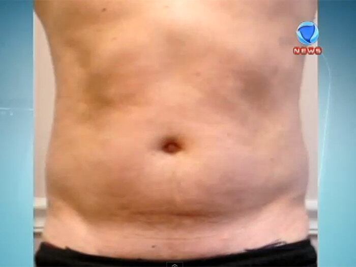 

Os homens, acredite, nem eles escapam. “Homens com um perfil
de pernas mais grossas. Enfim, um corpo mais arredondado podem ter celulite. Ou
situações que você evolua com distúrbio hormonal. Que você tenha uma grande
reposição de gordura poderiam facilitar”, destacou a dermatologista Denise
Steiner

