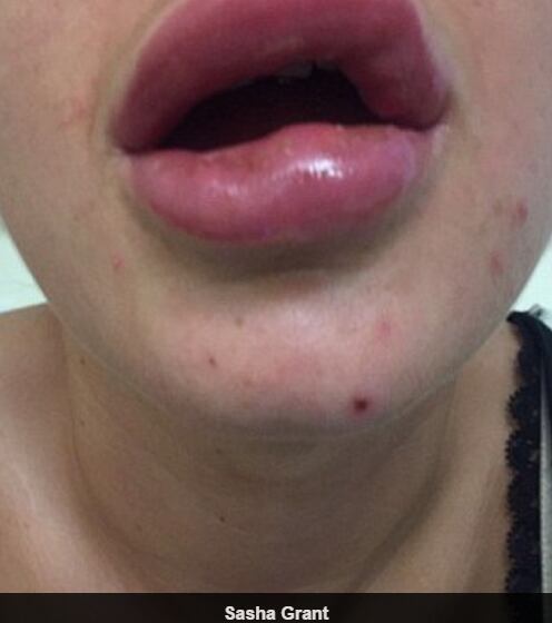 Uma mulher acabou internada em um hospital por cinco dias após fazer preenchimento labial “de Cinderela”, já que o efeito duraria apenas alguns meses. O procedimento deu errado e a paciente precisou de atendimento urgente porque corria o risco de parar de respirar devido ao inchaço.

— É como se meus lábios tivessem explodido

