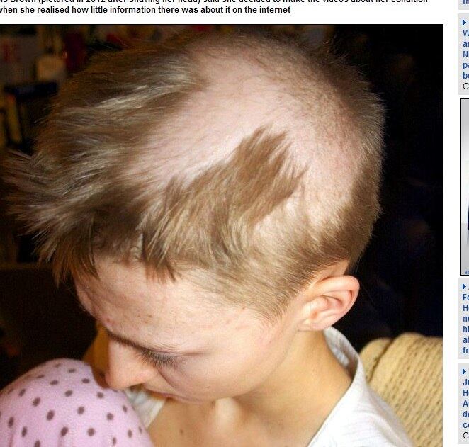 O hábito de puxar os fios de cabelo deformou a aparência da estudante
Rebecca Brown, de 20 anos. A “mania” começou aos 12 anos e a quantidade
de cabelo foi reduzindo até ela ficar quase careca. A jovem não sabia que sofria de uma doença chamada tricotilomania — transtorno psicológico que faz com que a pessoa arranque fios de cabelo para controlar a ansiedade e o estresse

Alisamento do cabelo: frequência do uso de formol é proporcional ao risco de câncer