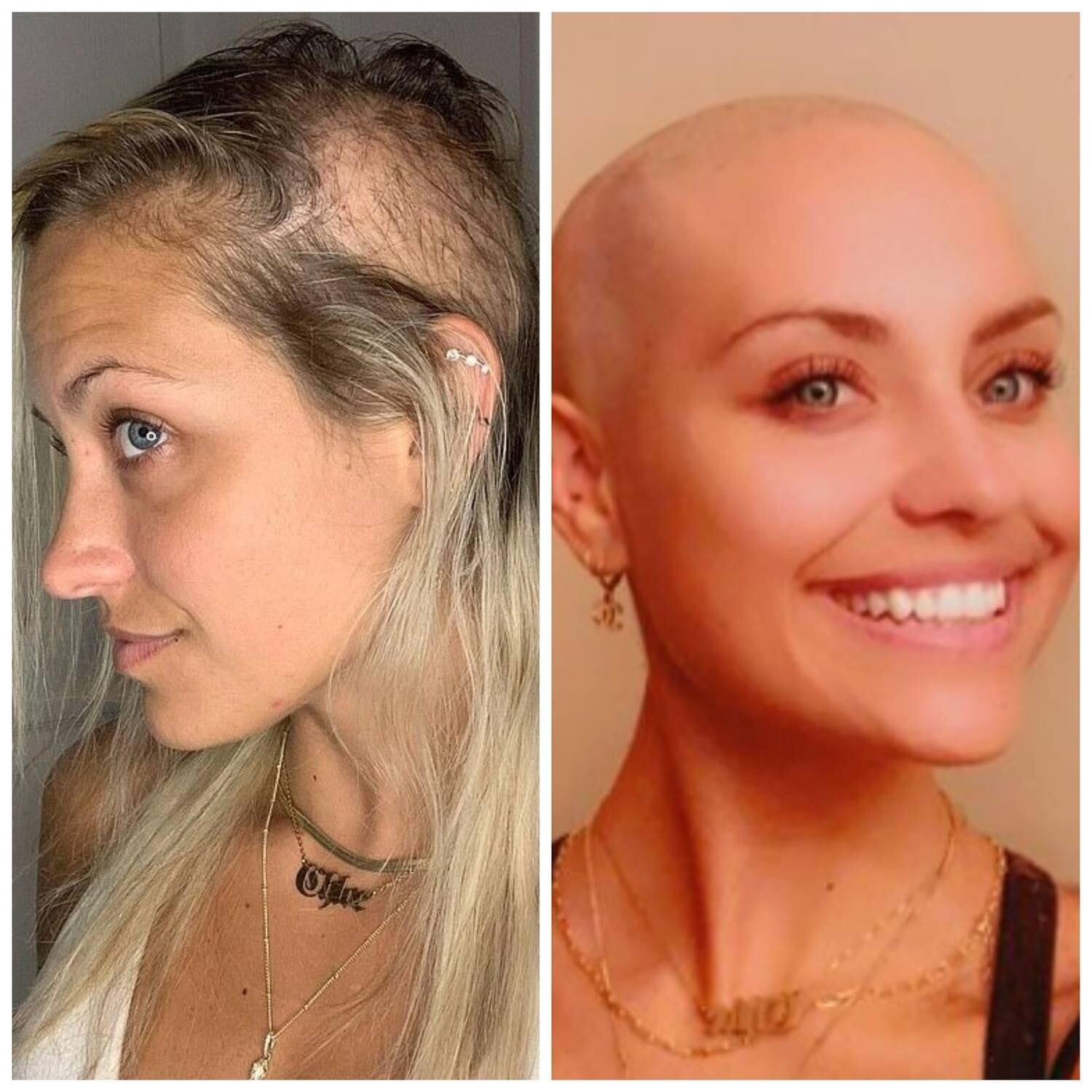 A americana Chloe Thomas, de 26 anos, foi diagnosticada com alopecia ainda na adolescência. Foram muitos anos tentando esconder a calvície com extensões de cabelo até que decidiu radicalizar para recuperar a autoestima. A influencer raspou a cabeça e hoje usa as redes sociais para encorajar outras pessoas e falar sobre a condição. Veja