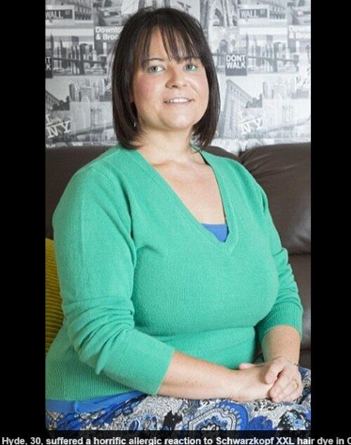 

Pouco antes de seu aniversário de 30 anos ela quis ficar
mais bonita e foi até a farmácia para comprar a mesma tintura que sempre usou.
Pouco tempo após a aplicação, ela estava cega, com coceiras na cabeça, e com o
rosto desfigurado

