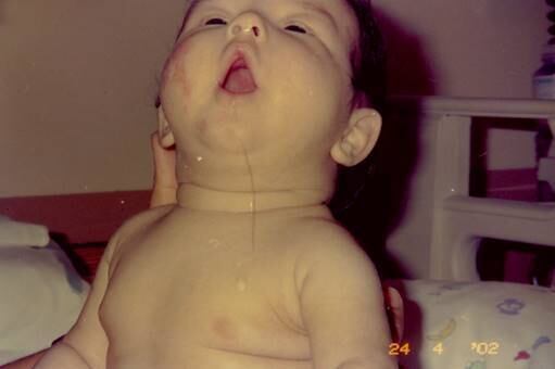 R7 — Logo depois
do nascimento de Artur, você e sua mulher já desconfiaram que a saúde dele
estava debilitada? 



Idário
Nogueira dos Santos —
O Artur nasceu em 18 de janeiro de 2002 e no primeiro dia de vida começamos uma
maratona de visitas a clínicas médicas. Com dois dias, ele foi internado em
coma. Ele fez vários exames para descobrirmos o motivo de ele estar vivendo como
um vegetal. Em Petrolina (PE), não tivemos muito sucesso e o transferimos para
Fortaleza onde o primeiro diagnóstico foi leucodistrofia [doença genética que
afeta o sistema nervoso], que estava equivocado. Eu pedi por uma segunda
opinião médica e, com 31 dias de vida, ficamos sabendo que ele sofria de uma
doença rara chamada DXB (Doença do Xarope de Bordo na Urina)