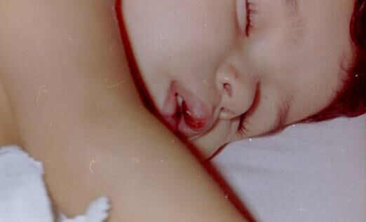 R7 — O que esta
doença causa na criança? 


Idário
Nogueira dos Santos —
É uma doença genética e hereditária causada pela deficiência de uma enzima
associada ao metabolismo de três aminoácidos que fazem parte da cadeia
ramificada da proteína e são essenciais para qualquer ser humano.  Esses três aminoácidos são chamados de
leucina, isoleucina e valina. Esta deficiência se manifesta na urina que exala
um cheiro doce de xarope, por isso o nome Doença do Xarope de Bordo na Urina.
Se não tratada, ela destroi as células do cérebro, causando retardo mental,
deficiências físicas, convulsões, coma e pode levar a morte