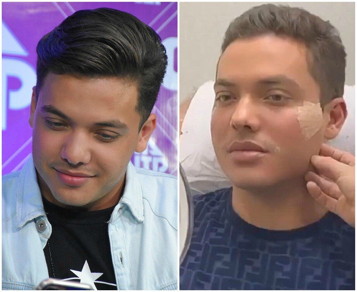 Cantor se rendeu à harmonização facial