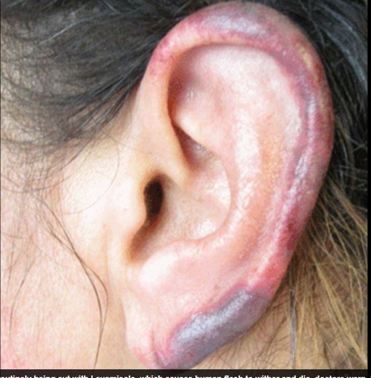 Desde ataques cardíacos à depressão e causa até a morte. Esses são os efeitos devastadores que a cocaína faz com os seus usuários. Além disso, as substâncias da droga também atacam as células sanguíneas e acaba escurecendo a pele. Veja imagens das consequências do uso da droga!