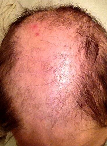 O diagnóstico de tricotilomania ocorreu quando ela tinha 14 anos. A doença, que ainda não tem cura, é baseada em situações de angústia que buscam um desafogo. Também pode se direcionar aos cílios e sobrancelhas. Ruth conta que a adquiriu após o divórcio dos pais. As informações são do The Sun
