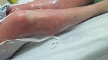 Queimadura Folha de Figo