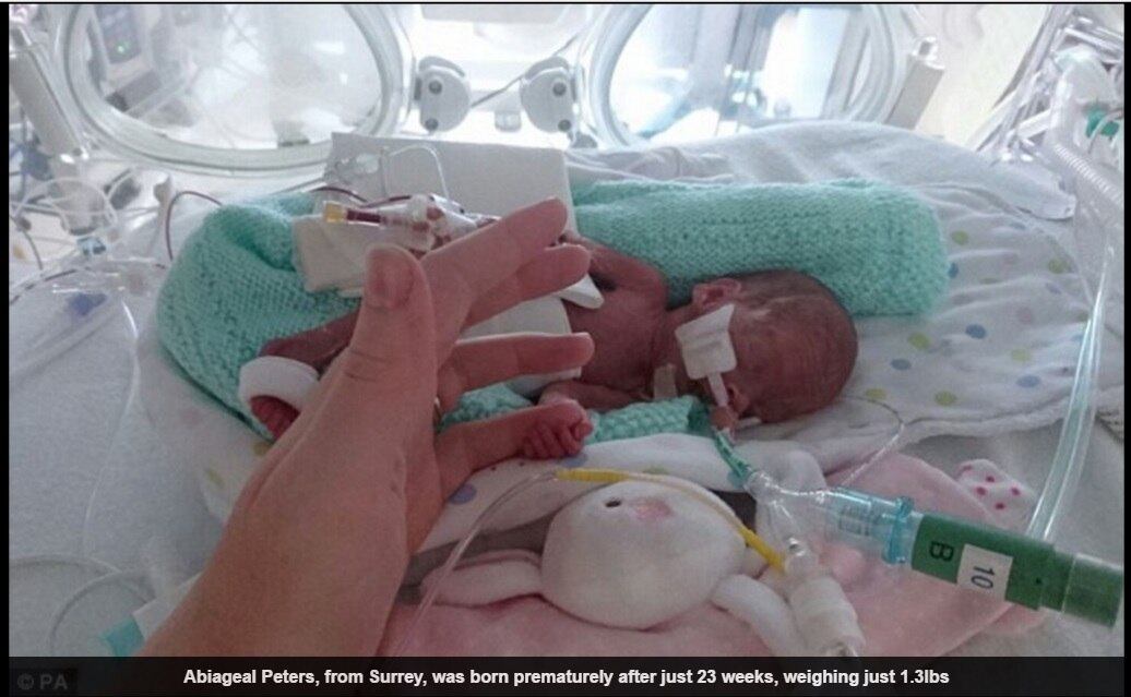 Abiageal Peters é a criança mais jovem a sobreviver a uma cirurgia na região abdominal