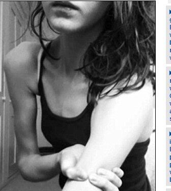 ― Comecei a me exercitar compulsivamente. Se eu não fizesse exercícios
e não cuidasse da minha alimentação, não conseguia dormir à noite. Ninguém sabia
desse meu problema até que comecei a automutilação  

Anoréxica com 29 kg quase teve mão amputada 
