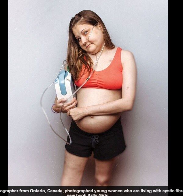 Um grupo de mulheres que sofrem com fibrose cística
descrevem as experiências de como convivem com a doença fatal, que atinge
pulmões e o pâncreas, formando uma mucosa, que causa infecções, falta de ar,
tosse frequente, e a dificuldade de ganhar peso. De acordo com informações do
site DailyMail, elas participaram do ensaio para mostrar que toda mulher
continua bonita, mesmo enfrentando a doença, e para ligar o alerta contra a
fibrose cística