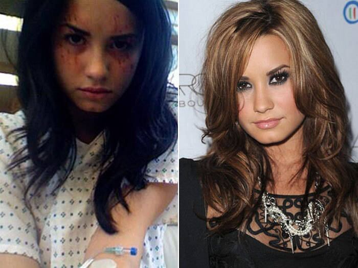 Na lista, ainda temos Demi Lovato, também cantora e atriz, internada em 2010 para tratar distúrbios mentais, bipolaridade, mutilação, bulimia e vícios em drogas