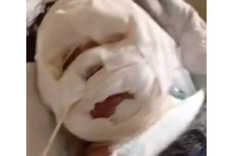 Menina está com o rosto completamente enfaixado