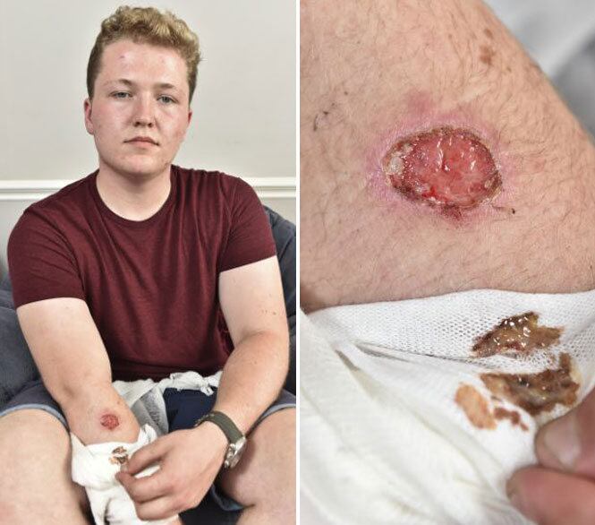 Este não é o primeiro caso de iPhones que superaquecem e ferem seus donos em 2014. Há apenas algumas semanas, Jake Parker, de 18 anos, acordou com uma queimadura dolorosa no braço depois de cochilar sobre seu iPhone 5