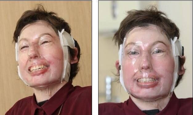 Durante a recuperação, a jovem precisou aprender a andar de
novo assim como fazer outras atividades cotidianas, entre elas, cozinhar e tomar
banho