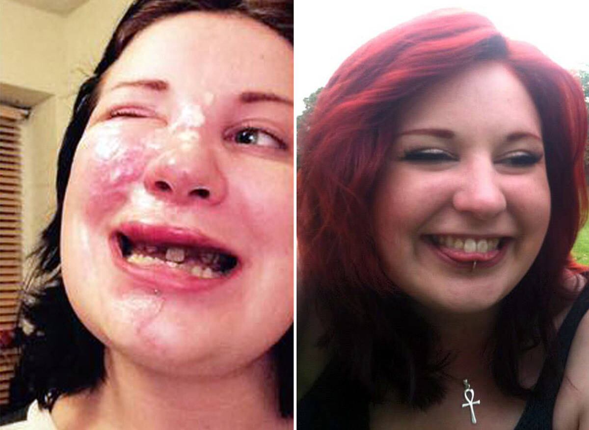 A jovem Zsuzsa Goodyer, de 25 anos, moradora de Cambridge, no Reino Unido, quebrou seus dentes e sofreu uma série de lesões em sua mandíbula, após um acidente de bicicleta em dezembro de 2015
