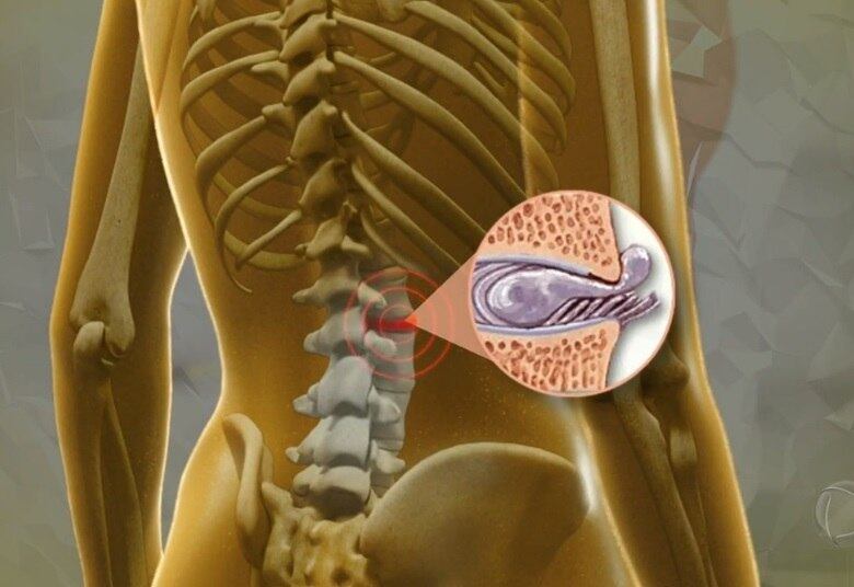 A doença pode se originar de fatores congênitos, que nascem com a pessoa, e os fatores adquiridos, que são, principalmente, sedentarismo e obesidade 