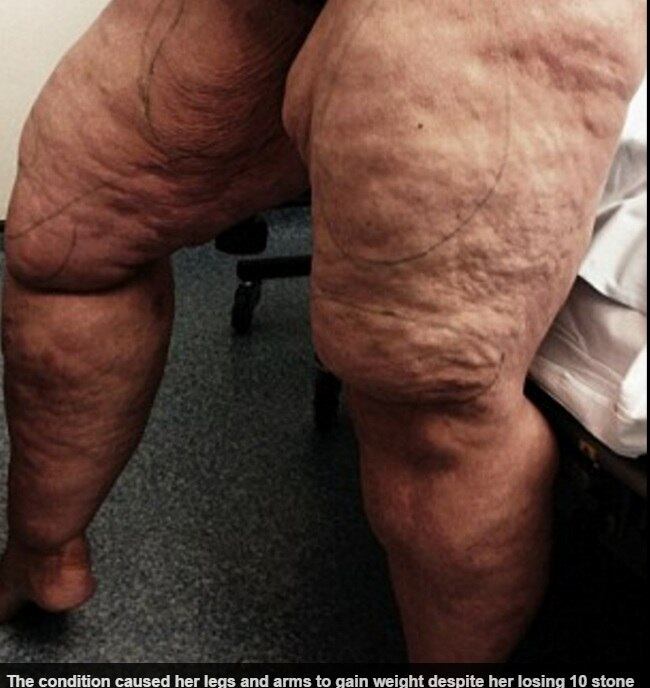 — Minhas pernas eram tão grandes que faziam uma coxa
esfregar tanto na outra me fazendo sentir extremamente desconfortável. Muitas
vezes, desenvolvia feridas e até sangrava