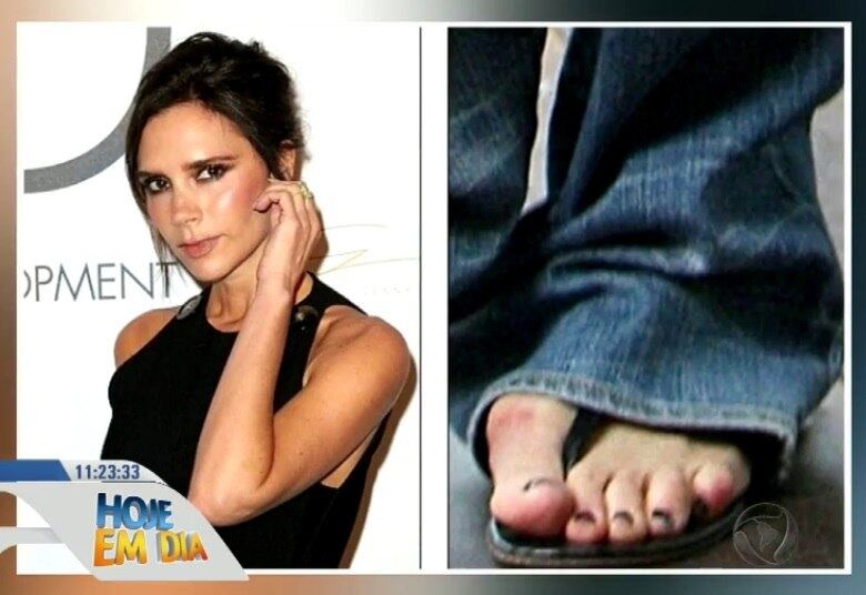 Em 2015, ela foi aconselhada pelos médicos a passar por uma
cirurgia para corrigir o problema, pois os remédios já não estavam mais
ajudando a aliviar a dor, tanto que sua postura também estava sendo afetada

• Você e o Doutor: aprenda a cuidar corretamente da saúde dos seus pés. ASSISTA! 
