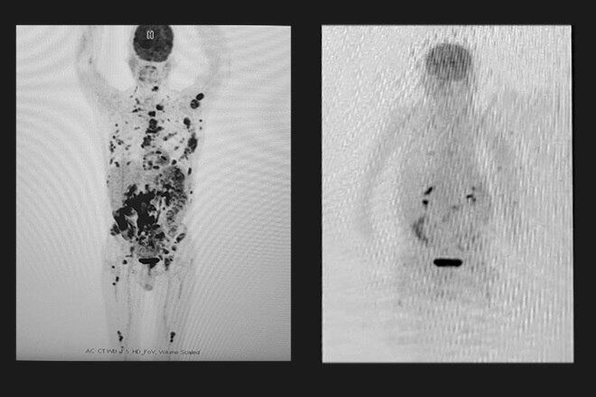 Imagem do corpo de Vamberto infestado pelo câncer e após o tratamento
