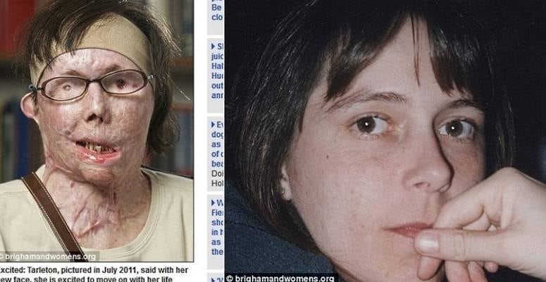 Em março de 2013, Carmen Tarleton, de 44 anos, conseguiu um transplante facial após ter o rosto queimado pelo marido. Carmen, de Vermont, nos Estados Unidos, sofreu queimaduras graves em mais de 80% de seu corpo e rosto.Saiba mais