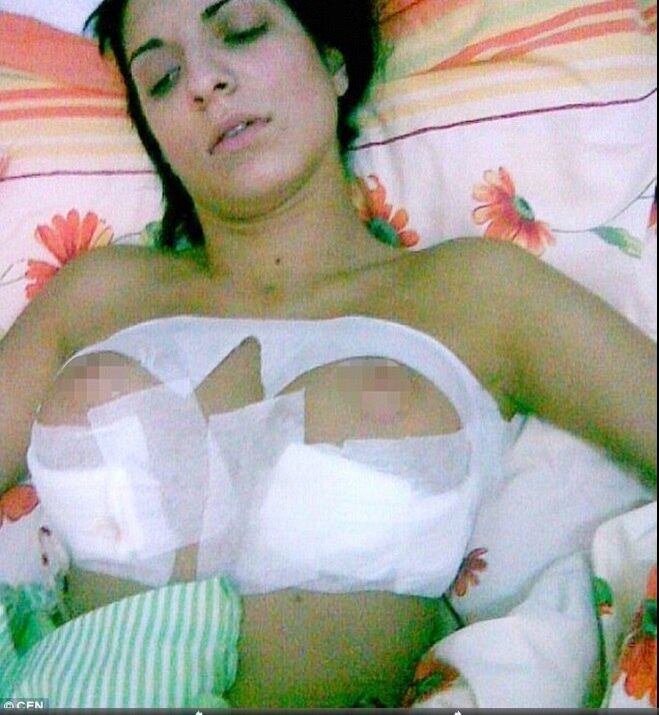 A apresentadora de TV e ex-modelo Andreea Tonciu, de 28 anos, da Romênia, ficou com os seios deformados, depois de implantar silicone nos seios. De acordo com informações do Daily Mail, ela quis divulgar fotos de
sua operação para alertar as mulheres a tomarem cuidado antes de realizarem esse tipo de procedimento