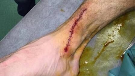 Verdier, atacante do Brest, sofreu uma entrada violenta num jogo pela Segunda Divisão do Campeonato Francês e precisou levar 14 pontos na canela. O responsável pelo machucado foi suspenso por seis jogos