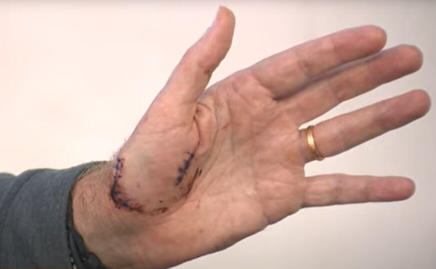 Segundo Murray, a mão estava em movimento durante a mordida