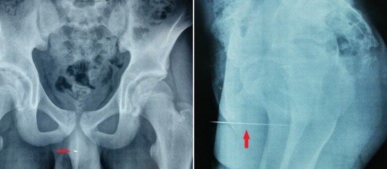 Médicos detectaram agulha após fazer um exame de radiografia