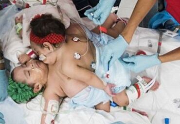Outro caso de sucesso na cirurgia é o das gêmeas Knatalye Hope e Adeline Faith Mata, de dez meses de idade. Elas nasceram ligadas pelo abdome e tórax