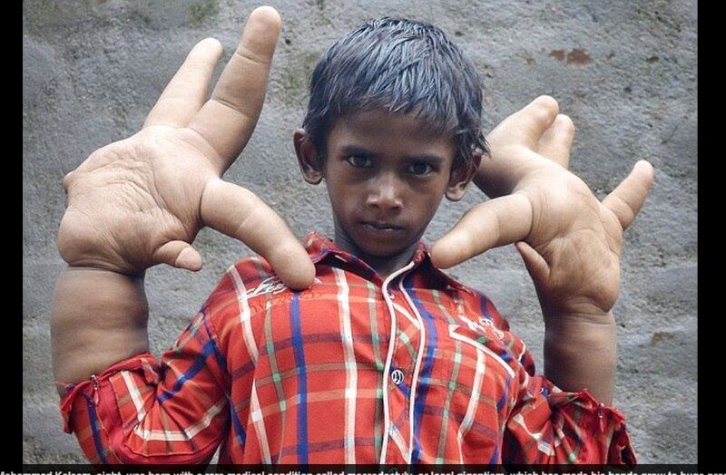 Kaleem já passou por situações
muito difíceis na vida, principalmente na escola, local no qual sempre sofreu
com brincadeiras maldosas das outras crianças, e até pela posição de algumas
escolas, que recusaram a matrícula do menino, “porque ele poderia assustar os
demais alunos”